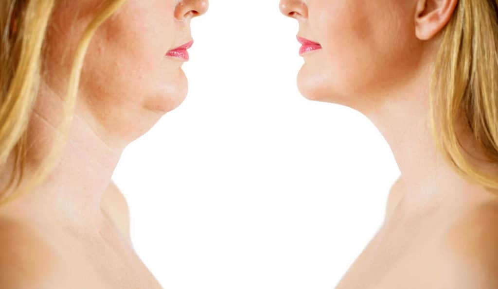 Double Chin treatment Southend before and after results