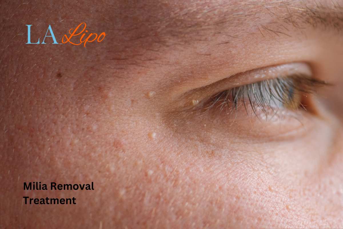 Cryopen Milia Removal: Is It the Easiest and Safest Option Southend?