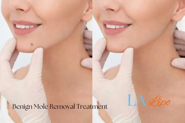 woman's before and after mole removal Southend results