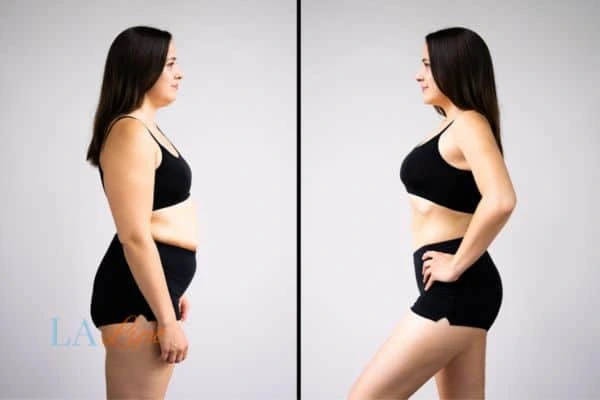 image of woman before and after results of LA-EMS Body Sculpting Southend to help treat Diastasis recti