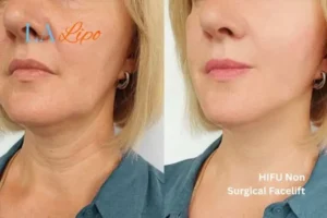 hi-fu for wrinkles Southend before and after results