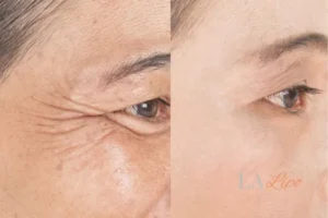 Before and after results of woman - HI-fu wrinkles reduction treatment Southend