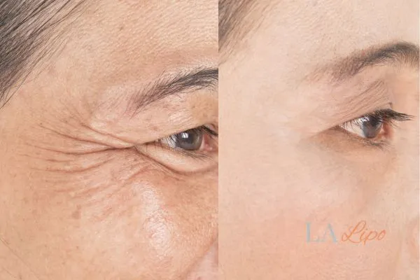 Before and after results of woman - HI-fu wrinkles reduction treatment Southend