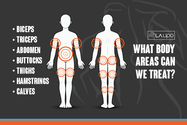 Graphic to show areas you can have LA-EMS Body Sculpting Southend treatment.