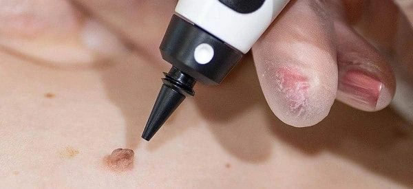skin tag removal using cryopen Southend