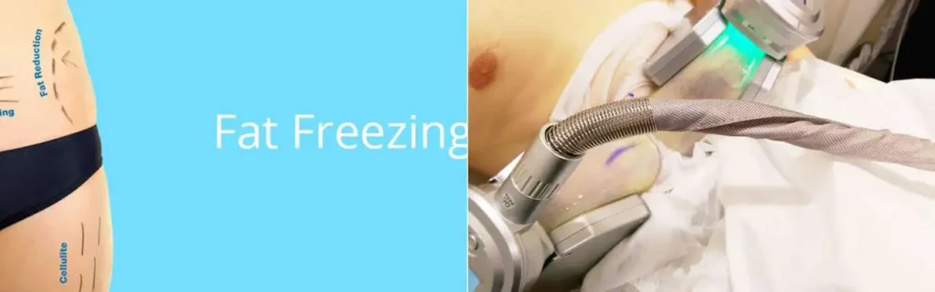 Fat freezing Southend on multiple areas of the body