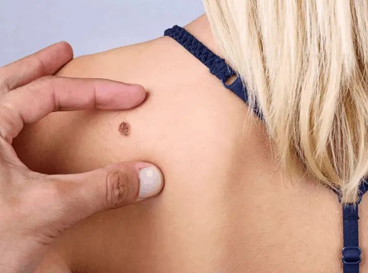 woman having mole removal Southend consultation before treatment.
