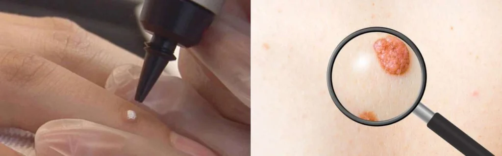 CryoPen practitioner Southend assessing a benign mole before treatment