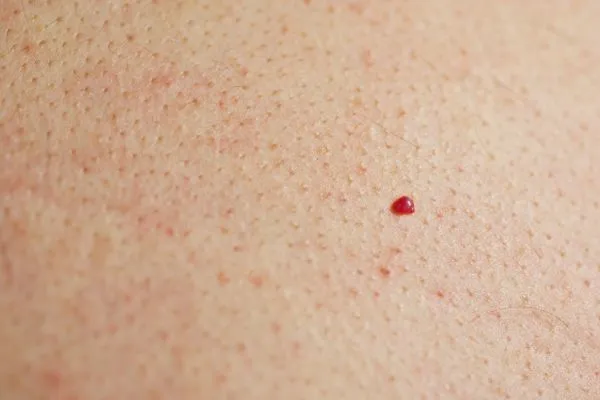 close up of a cherry angioma Southend