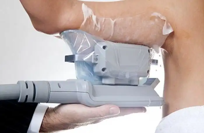 Picture of fat freezing Southend on the upper arms.