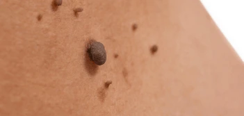 image of a skin tag Southend