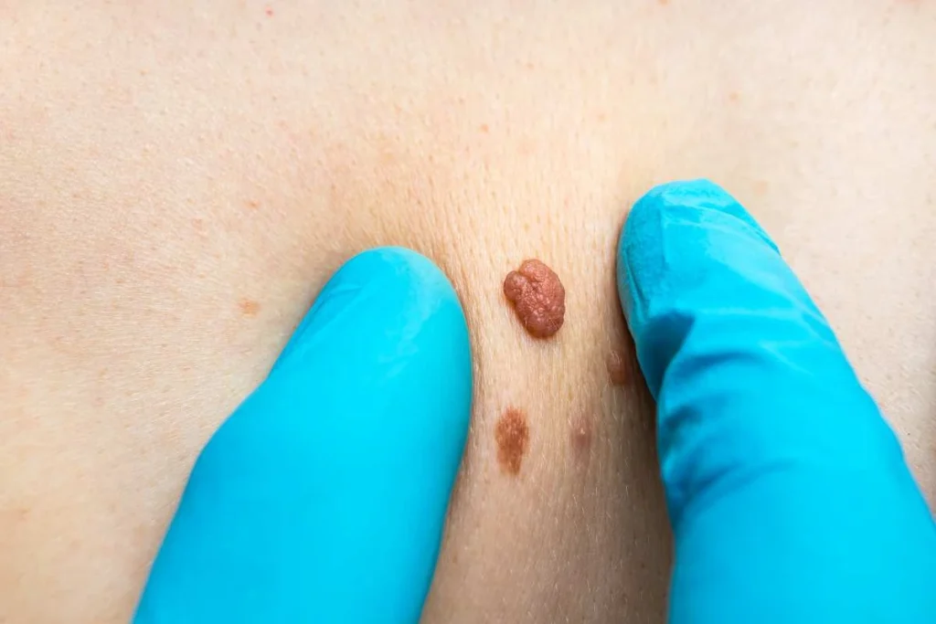 Consultant examining a skin tag Southend