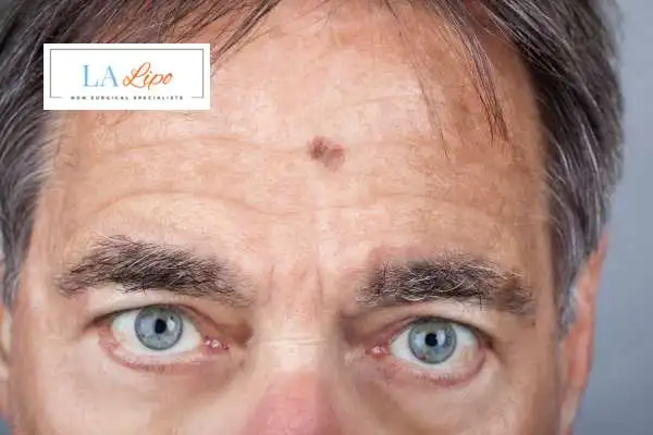 Solar Lentigo Removal Southend image of man with mark on his forehead