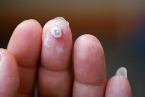 wart on person finger - cryotherapy to treat from LA LIPO Southend