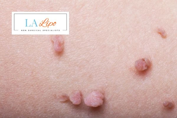 Does cryopen skin tag removal Southend hurt? Find out now call our team today!