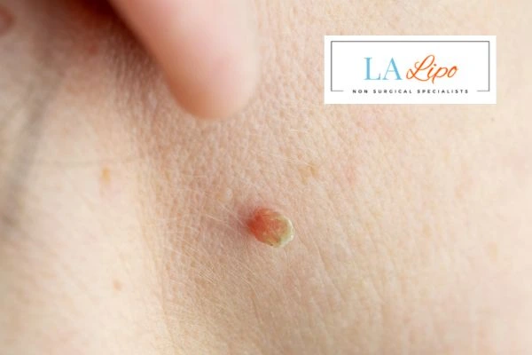 Book skin tag removal Southend today speak to our team now!