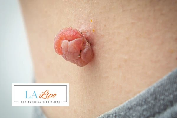 Interested in skin tag removal Southend? Concerned about the pain? Find out more today!
