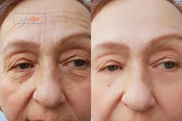 The powerful benefits of Morpheus8 Treatment Southend - Call Our team today!