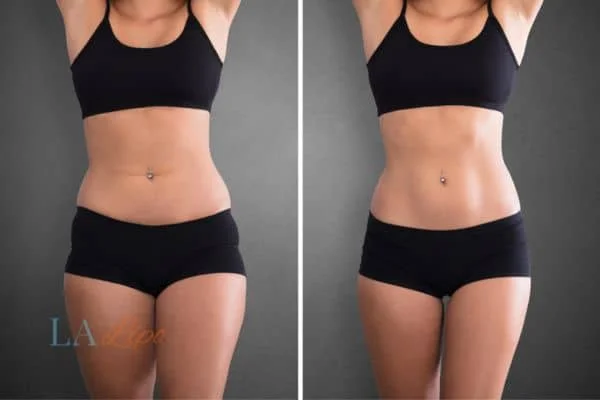 before and after results of non-surgical treatment to help a woman's body image and mental health Southend