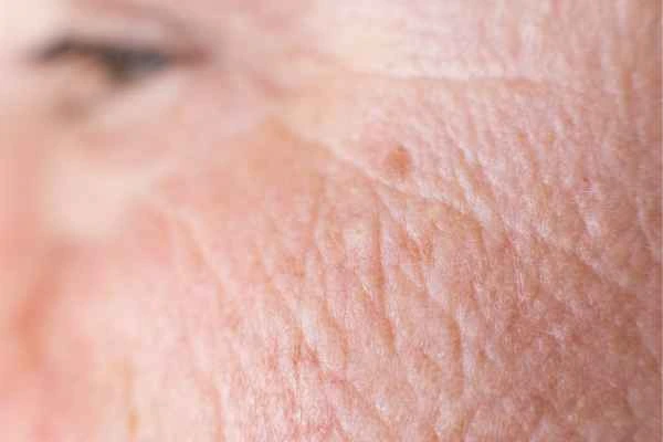 close up picture of a woman's face showing an age spot Southend