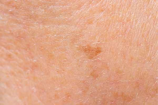 close up picture of age spots Southend