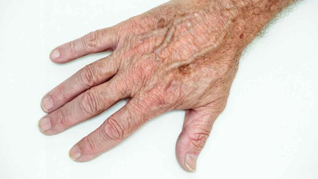 Male hand showing age spot Southend