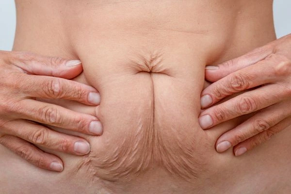 Should I Combine Diastasis Recti Treatment with Body Contouring for Better Results Southend?