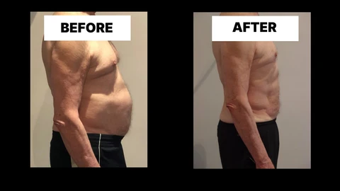 What Symptoms Can Diastasis Recti Cause in Men? Weak Core, Back Pain and Poor Posture Southend